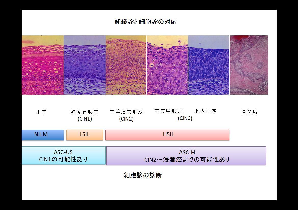 子宮頸癌検診で異常といわれたら 腫瘍について 一般の皆様へ 徳島大学病院産婦人科