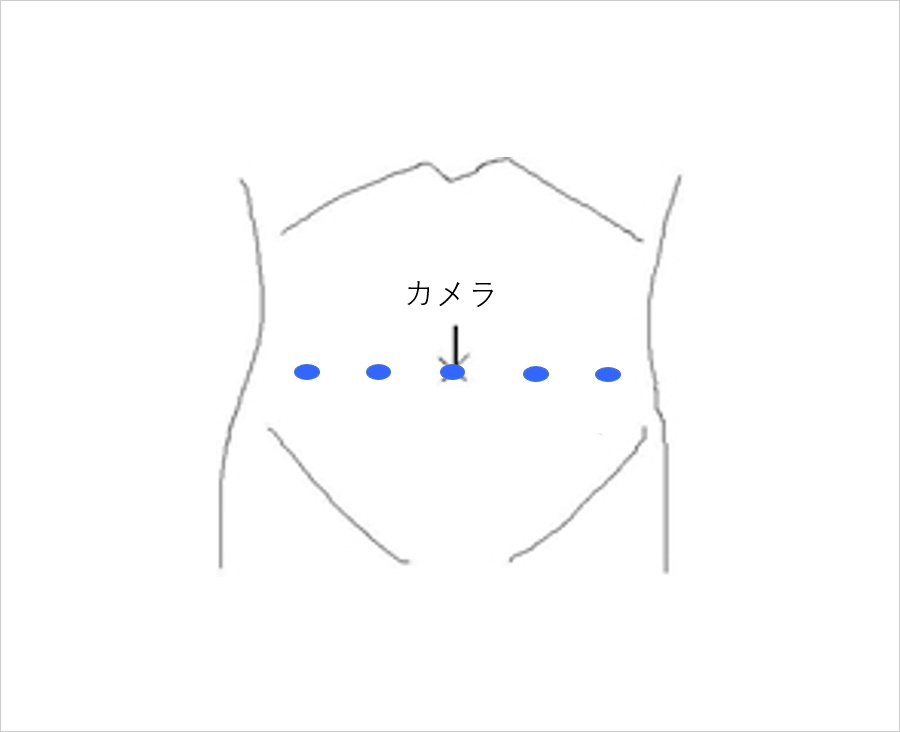 ロボット支援手術の図解